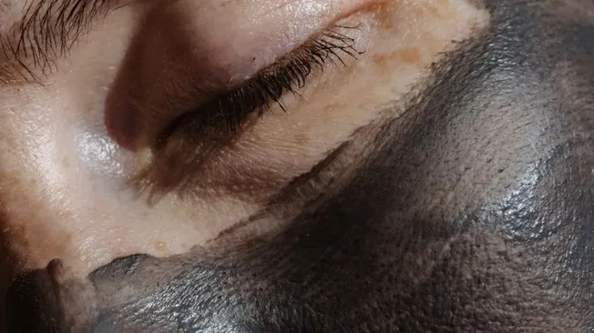 How Does Exfoliation Help with Acne